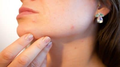 Rosacée : symptômes, causes... tout savoir sur cette maladie de peau !